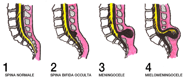 Différents Spina Bifida