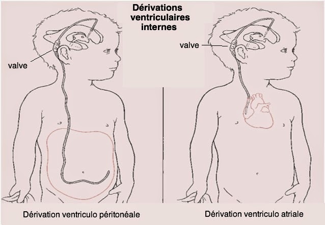 Dérivation ventriculaires internes