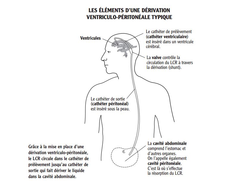 Dérivation ventriculo-péritonéale