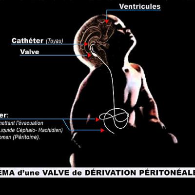 Derivation Péritonéale