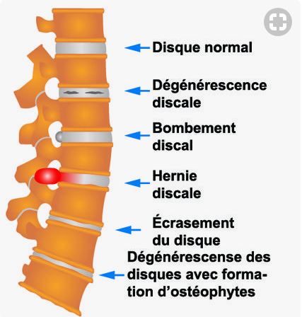 Disques Lombaires