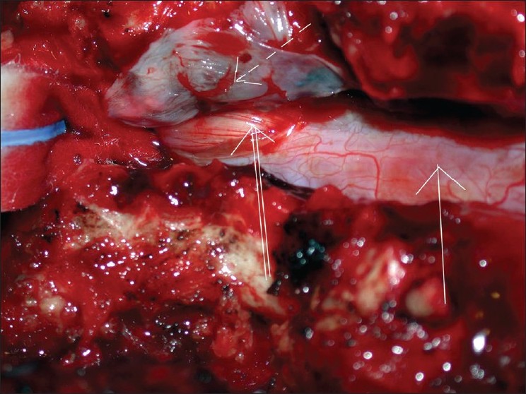 JSurgTechCaseReport_2011_3_1_40_78472_f4 (1)