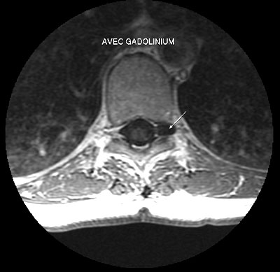 kyste-dorsal-axial-gado