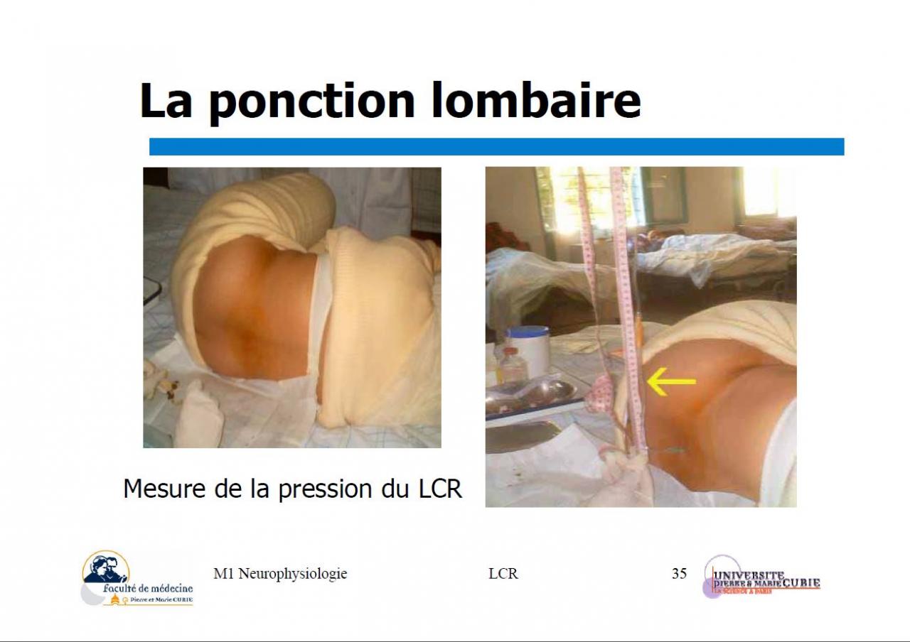 La ponction Lombaire b