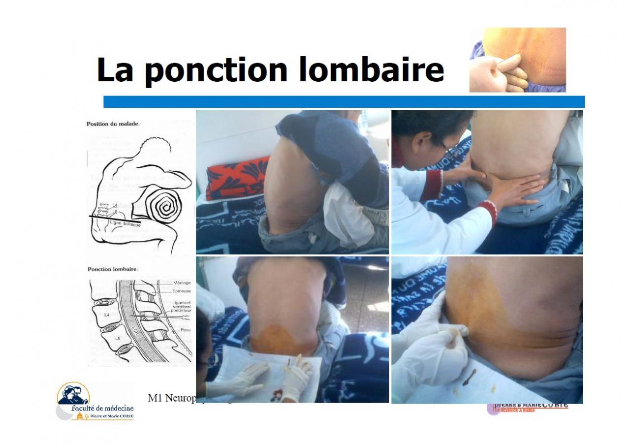 La ponction Lombaire