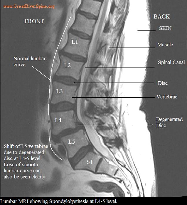 lumbar-spondylolystthesis