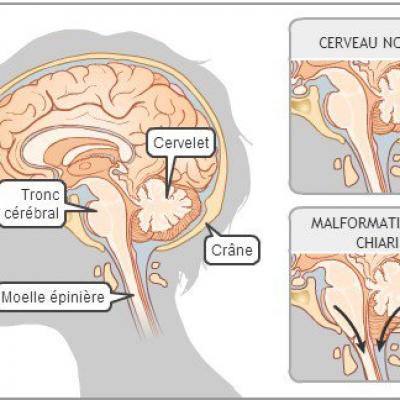 Malformation de Chiari