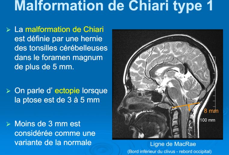 Malformation chiari type 1