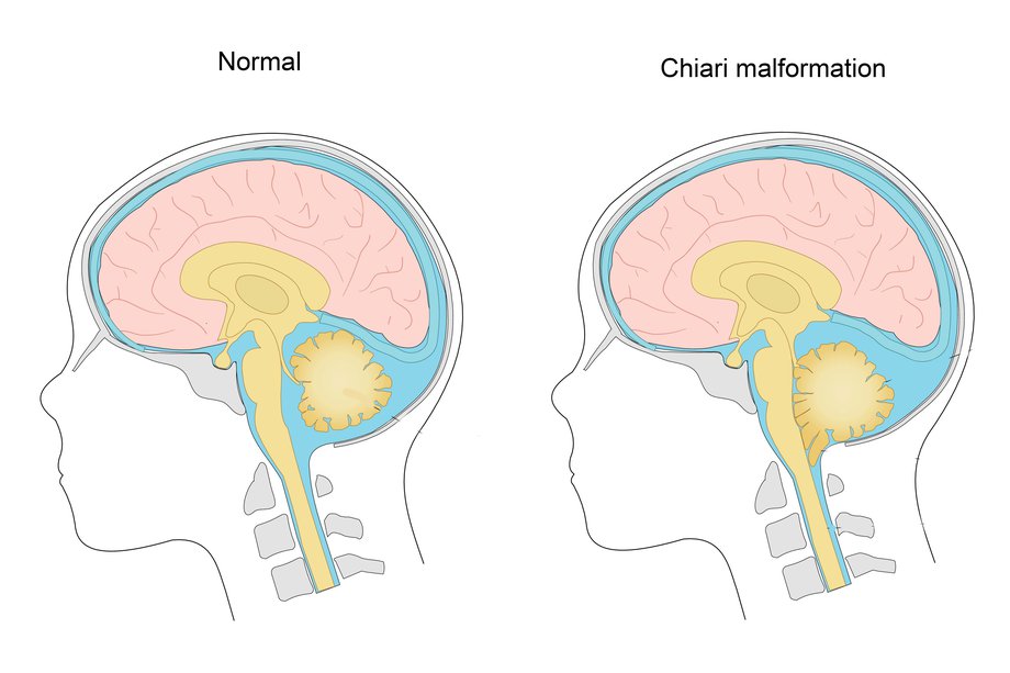 Malformation CHIARI