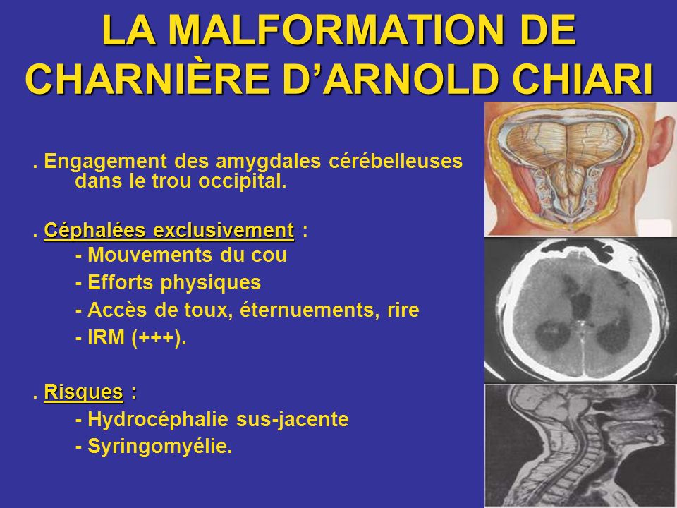 Malformation de CharnièreD’ARNOLD CHIARI