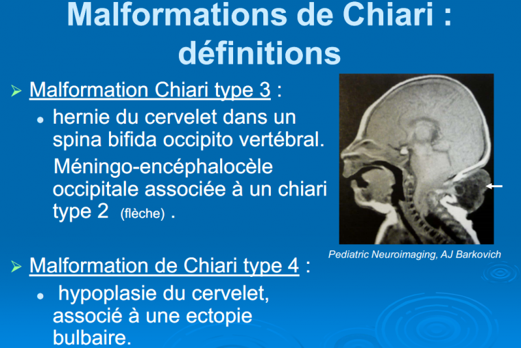 Malformations de Chiari : définitions