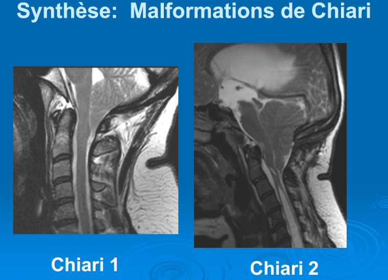 Malformations de Chiari