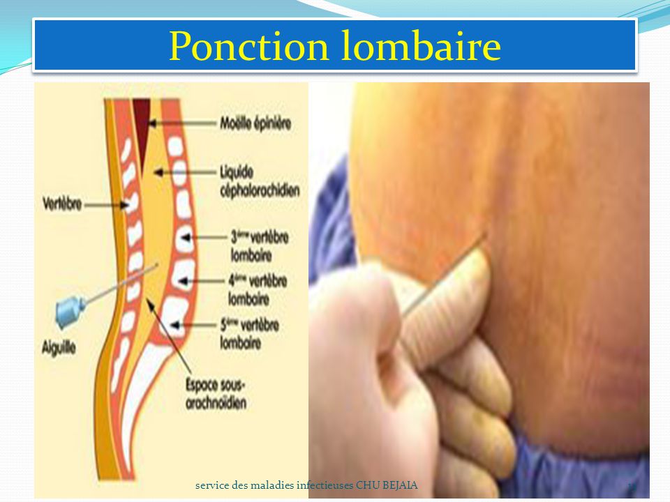 Ponction+lombaire+service+des+maladies+infectieuses+CHU+BEJAIA