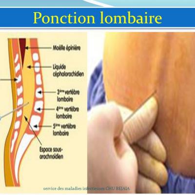 Ponction Lombaire