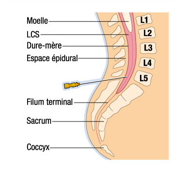 Ponction lombaire1