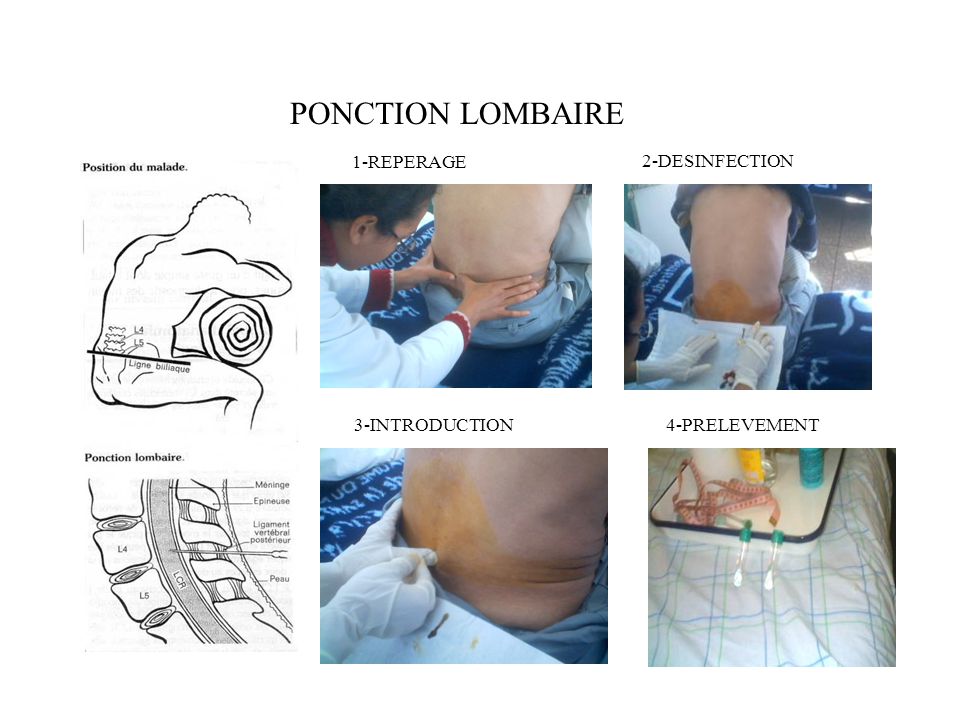 Ponction Lombaire