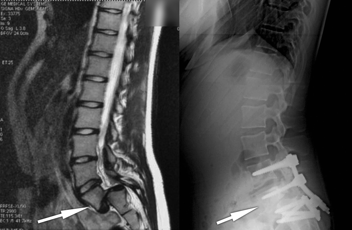 Spondylolisthesis03_rx