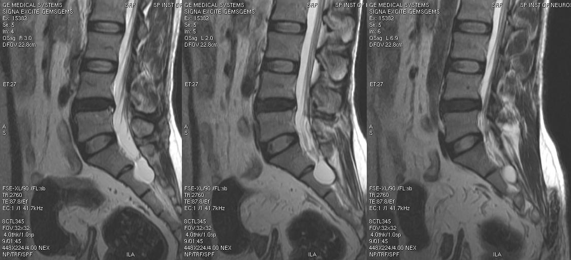 tarlov cyst1