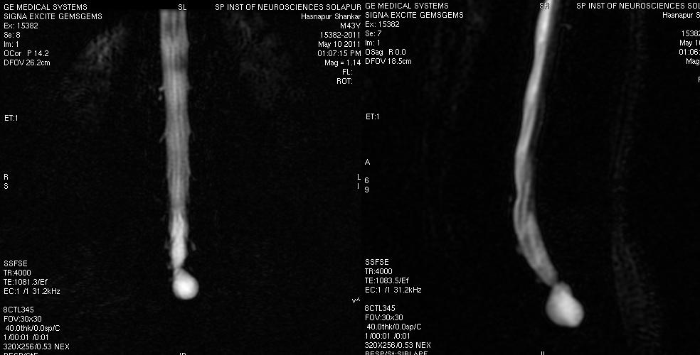 tarlov cyst2