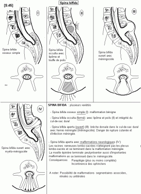 S 45 spina bifida