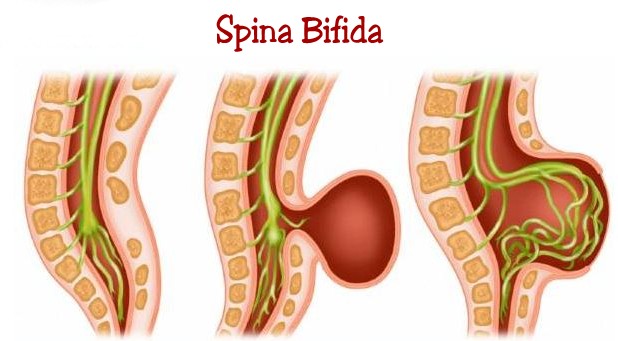 Spina bifida